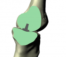 Tibia with Implant