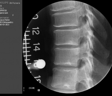 Lumbar Spine X-ray from Philips BV Pulsera