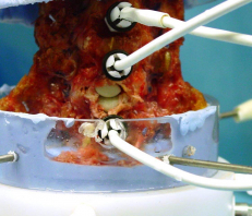 Cervicalspine in MTS in flexion