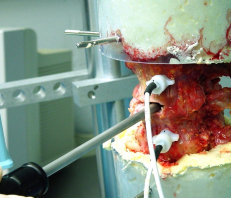 Cervicalspine in MTS in flexion