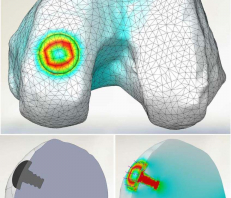 Design Knee Composite