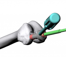 PIR Surgical Procedure