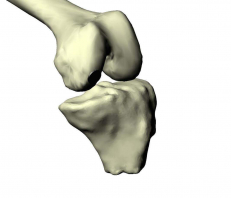Tibia with Implant